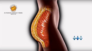 Procedimento cirgurgico